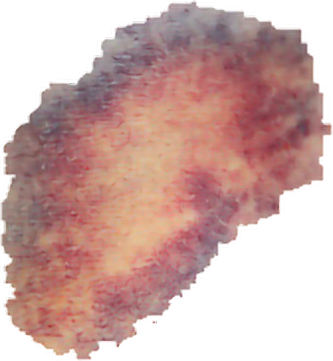 Collection Of Free Bruising - Transparent Bruise Png - Free Transparent ...