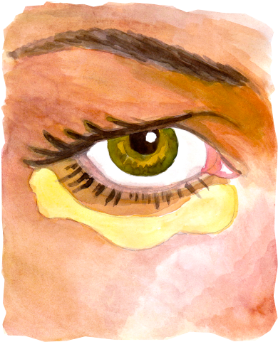 Diagram Of Fatty Bags And Incisions - Sv Plastinės Chirurgijos Centras (480x579), Png Download