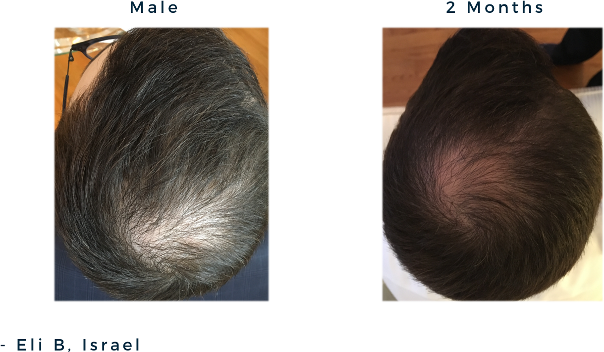 Male 20y, Androgenic Alopecia / Male Patterned Balding (1395x754), Png Download