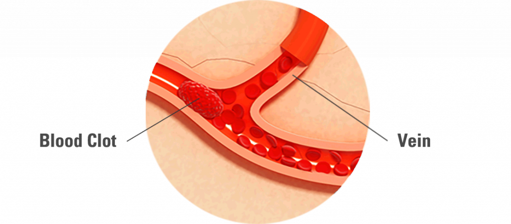 Blood Clots Are Thickened Clumps Of Blood That Can - Wood (1024x449), Png Download