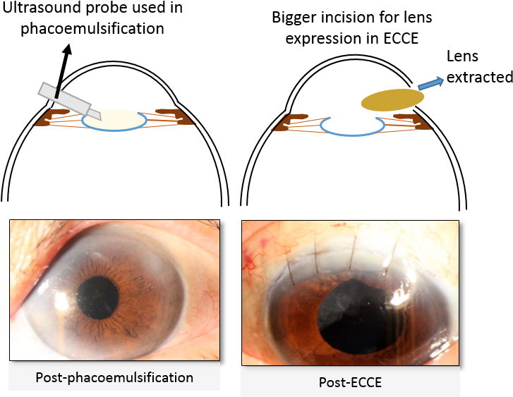 Cataract Surgery - Circle (813x583), Png Download