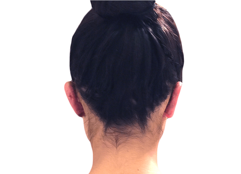 After Ear Surgery - Girl (850x600), Png Download