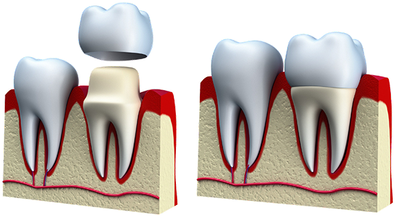 Crowns & Bridges - Crowns Bridges And Veneers (586x360), Png Download