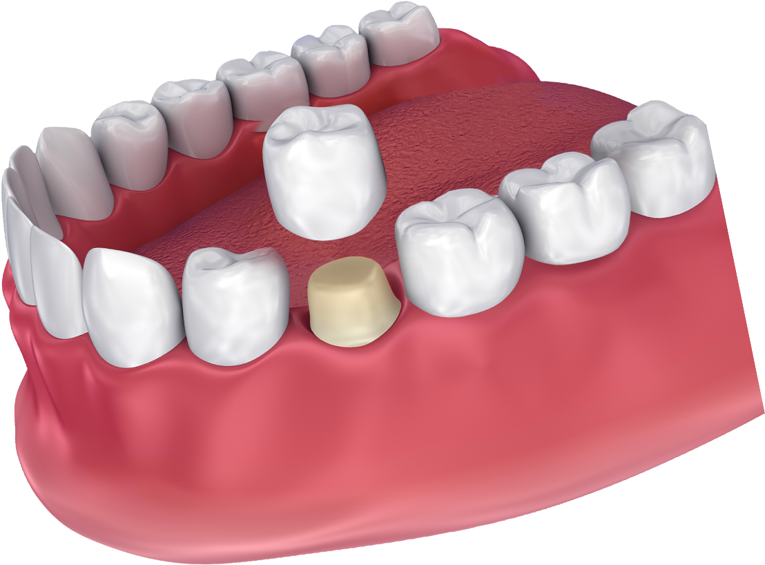 Digital Image Of A Dental Crown Being Placed - Dental Crown (1200x1200), Png Download
