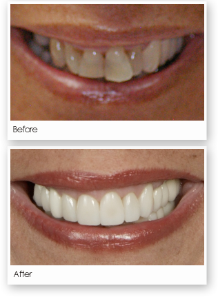 Crowns - Lieberman Larry T Dds Pa (316x431), Png Download