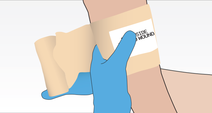 The Pressure Dressing - Junctional Rhythm (690x368), Png Download