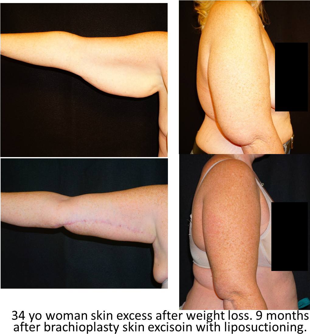 Arm Lift - Photo Caption (1054x1126), Png Download