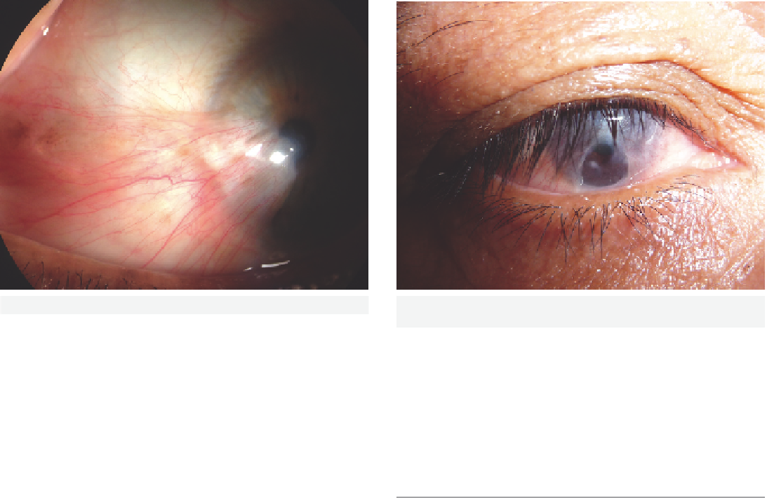 Ocular Surface Disease - Pterygium (1093x710), Png Download
